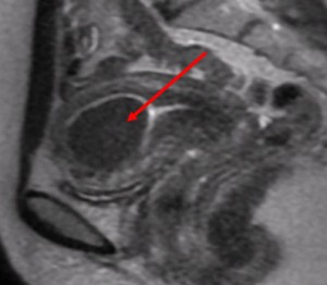 MRI shows fibroid inside the uterine cavity