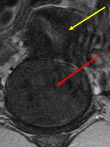 MRI. Yellow arrow is pointing to the uterus, the red arrow is pointing to the cervical fibroid