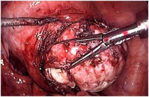 Laparoscopic myomectomy removes fibroids