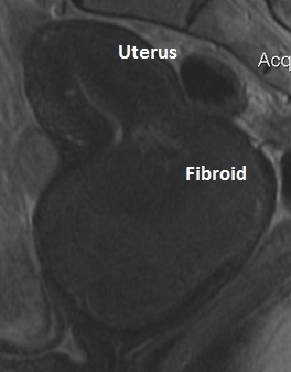 Fig: Fibroid Prolapsing through the Cervix and into the Vagina